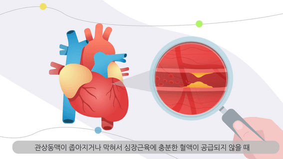 드롭샷매치 포트폴리오 - 대학병원 심장질환 설명영상
