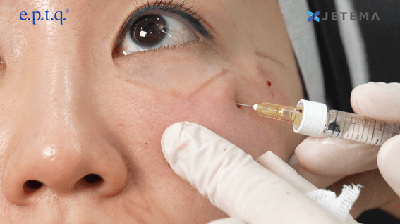 드롭샷매치 포트폴리오 - 제테마 눈밑 시술 강의 영상