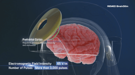 드롭샷매치 포트폴리오 - 의료기기(재택용 TMS 기기) 제품 홍보영상