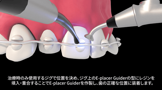 드롭샷매치 포트폴리오 - 이와이어라이너 치아교정 벨로드롬 와이어 부착 안내영상