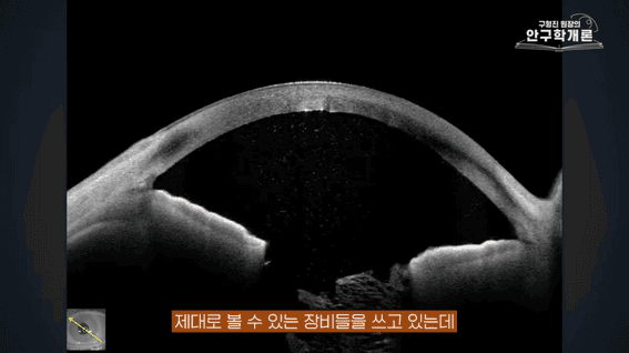 드롭샷매치 포트폴리오 - [안구학개론] ICL 렌즈삽입술 받기 전에 한 번쯤 생각해 볼 이야기ㅣ눈에미소안과