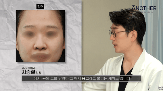드롭샷매치 포트폴리오 - 어나더 성형외과 컨텐츠 용코편